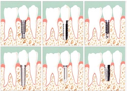 Implantes Dentales y Rehabilitacion Oral en Medellin